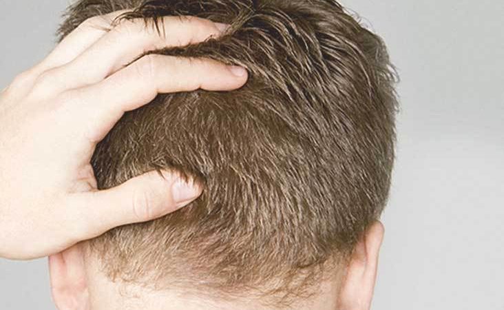 השתלת שיער לגברים – מה חייבים לדעת לפני