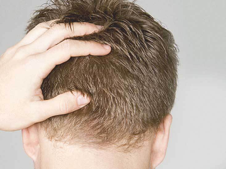 השתלת שיער לגברים – מה חייבים לדעת לפני