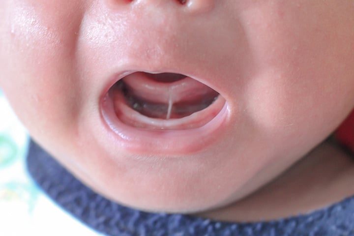 לשון קשורה אצל תינוקות – ממצאים, מחקרים וחיתוך לשון קשורה