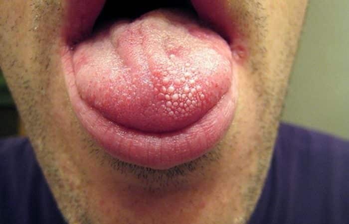 קונדילומה בפה – יבלות וירוס הפפילומה