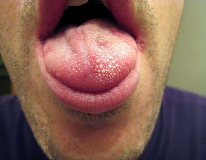 קונדילומה בפה – יבלות וירוס הפפילומה
